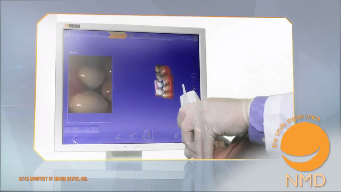 Screen Capture from Cerec Video